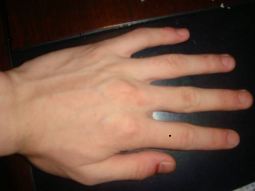 女生左手食指有痣图片
